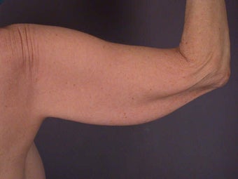 Arm Lift before 281288