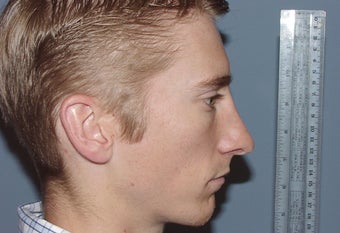 Correction of excessively thinned out nose following primary nasal surgery 892539
