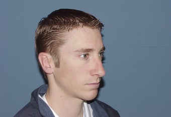 Correction of excessively thinned out nose following primary nasal surgery after 892539