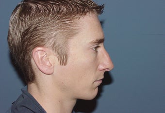 Correction of excessively thinned out nose following primary nasal surgery 892539