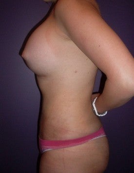 Laser Liposuction after 561156