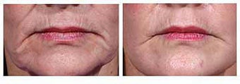 Restylane for wrinkles before 6265