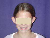Otoplasty before 87695