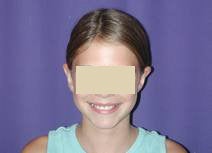 Otoplasty after 87695