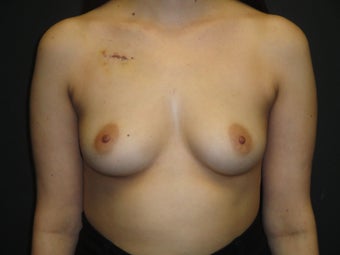 Breast reconstruction - Implants before 912589