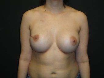 Breast reconstruction - Implants after 912589