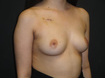 Breast reconstruction - Implants 912589