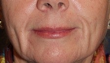 Soft Tissue Fillers Before & After Photos before 969768