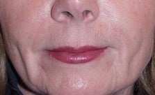 Soft Tissue Fillers Before & After Photos after 969768