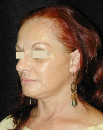 Facelift / Necklift after 103850
