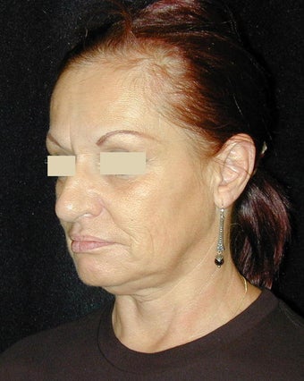Facelift / Necklift before 103850