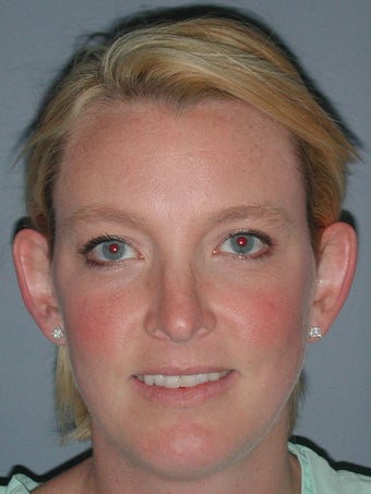 Otoplasty, Ear Surgery before 731965