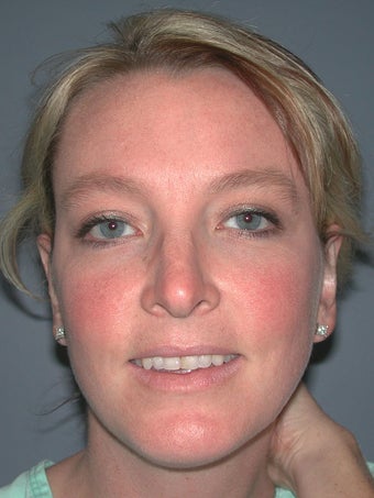 Otoplasty, Ear Surgery after 731965