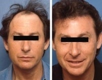 Hair replacement before 130786