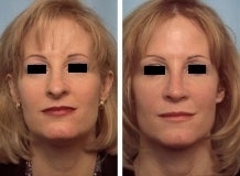 Rhinoplasty before 143648