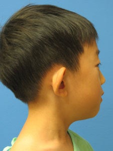 Otoplasty Ear Surgery - Boy 818049