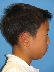 Otoplasty Ear Surgery - Boy 818049