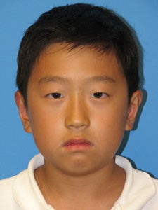 Otoplasty Ear Surgery - Boy after 818049