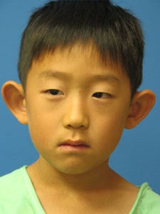 Otoplasty Ear Surgery - Boy before 818049