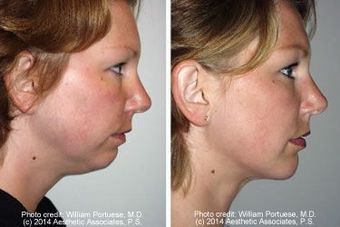 Liposuction of chin with a chin implant before 6805