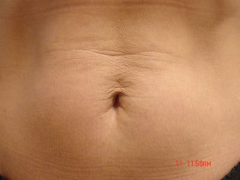 Thermage before 233684