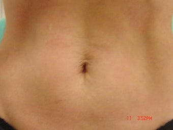 Thermage after 233684