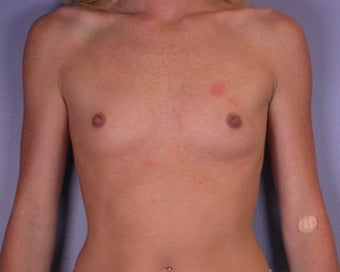Breast Augmentation before 281404