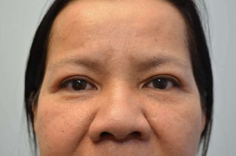55 Year Old Female Treated for Droopy Eyelids after 1138000