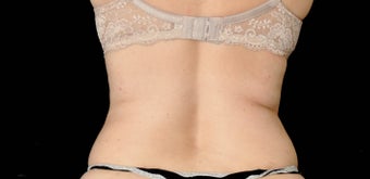 CoolSculpting before 483049