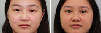 Double Eyelid (Asian Blepharoplasty) Incisional before 596682
