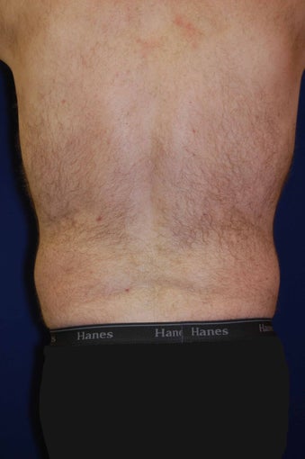 Liposuction of Waist after 565678