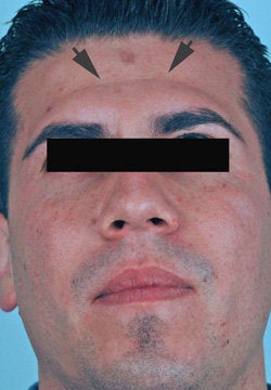 Botox treatment for forehead before 91060