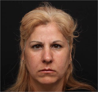 Restylane & Juvederm before 444312