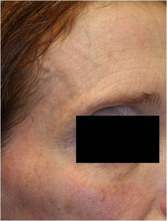 Fraxel - Photoaging after 652368