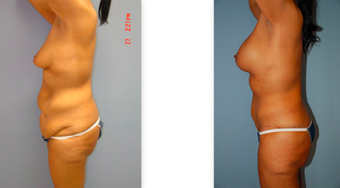Tummy tuck, breast lift and implants, liposuction before 307051