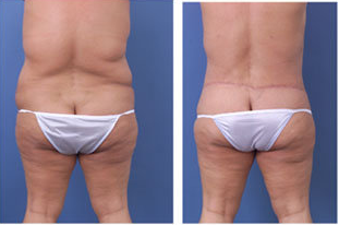Central body lift with liposuction of thighs and back, age 42 after 6815
