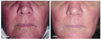 VBeam for rosacea before 44907