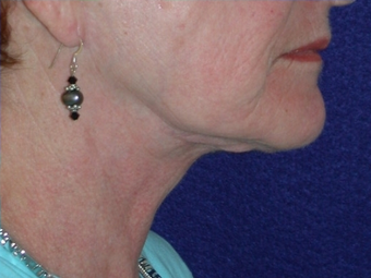 Necklift 208438