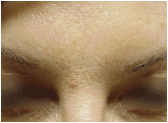 Botox after 267385