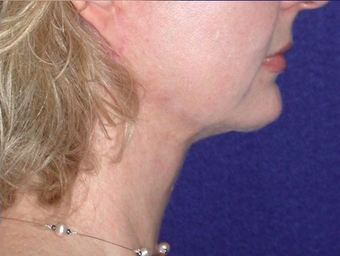 Necklift 208455