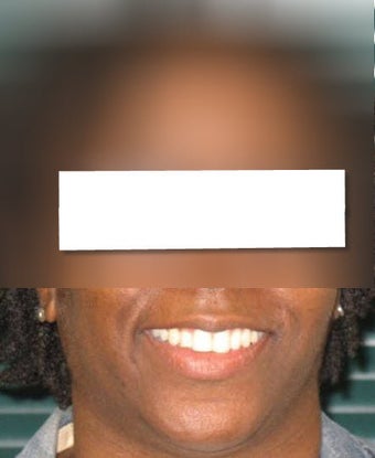 Invisalign after 437118