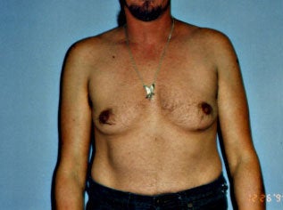 Male Breast Reduction before 264606