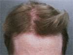 Hair Transplant before 426674