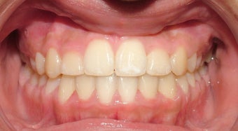 Teen Orthodontic Treatment (case #3MM) after 224584