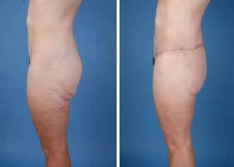 Flank Excision after 303674