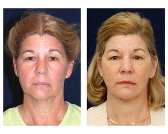 Lower Face and Neck Lift before 355159