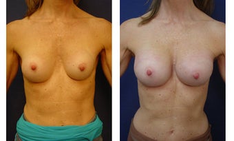 Breast implant correction before 399965