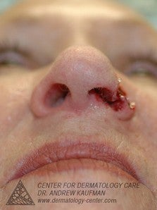 Mohs Surgery of Basal Cell Carcinoma and Recontruction after 315015