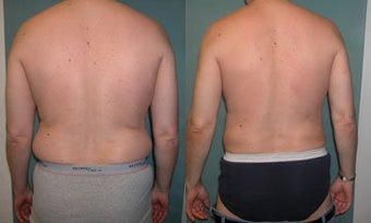 Smart Lipo of Male Abdomen/Flanks before 331972