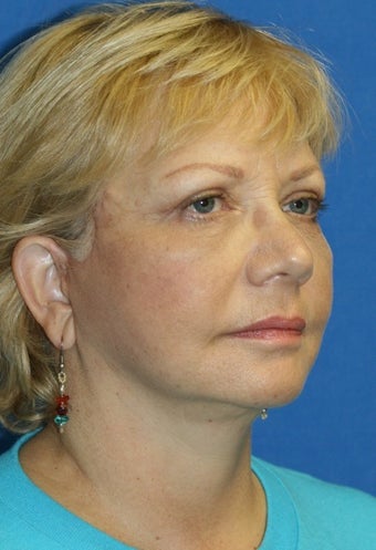 Face Lift 367591